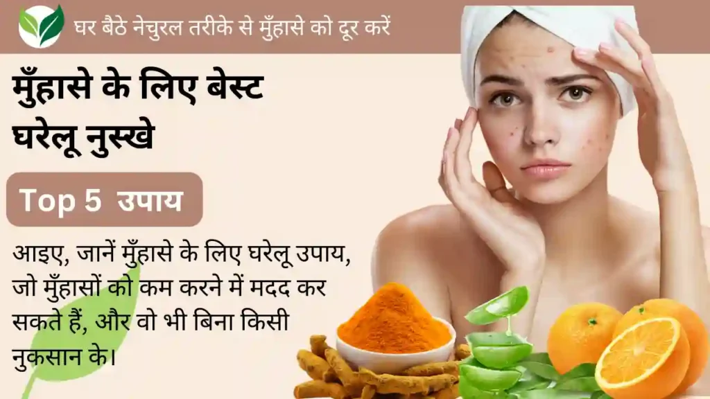 मुँहासे के लिए घरेलू उपाय